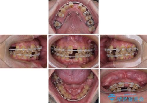 放置した歯列　矯正治療とインプラント治療で劇的に改善の治療中