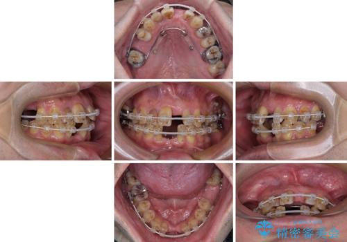 放置した歯列 矯正治療とインプラント治療で劇的に改善の治療中