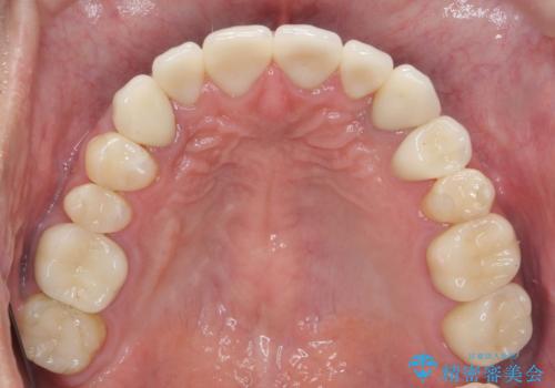 歯並びと虫歯(メタルフリー)を行った全顎治療の治療後