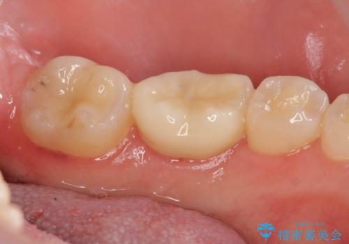 歯冠長延長術をおこなったアプローチの難しい虫歯治療の症例 治療後