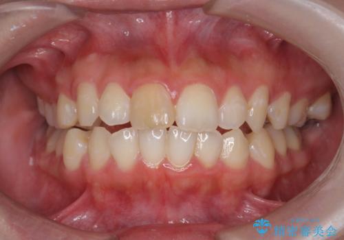 前歯の変色をキレイに セラミッククラウン審美治療の治療前