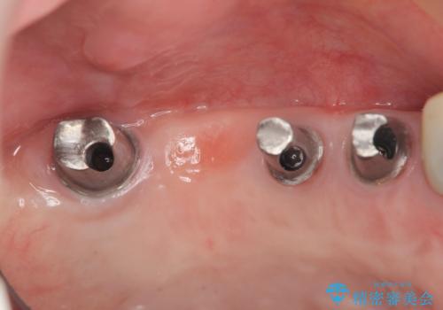 歯周病で失った歯をインプラント治療で咬合機能回復の治療中