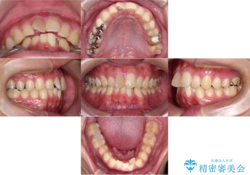 【インビザライン　非抜歯】歯の捻じれと歯のでこぼこを治したい!の治療前