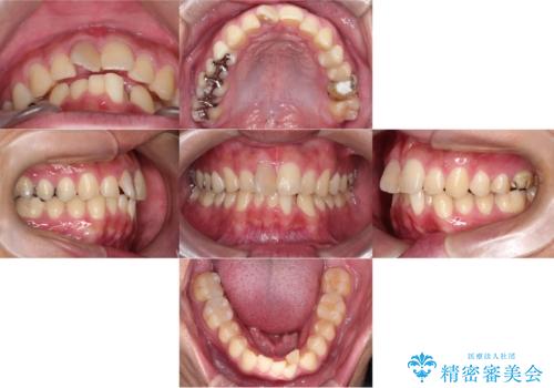 【インビザライン 非抜歯】歯の捻じれと歯のでこぼこを治したい!の治療前