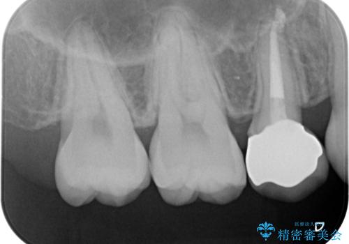 奥歯の神経のない歯をセラミックでしっかり治療の治療後