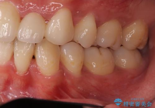 重度のがたつき 矯正治療+セラミック治療で綺麗な歯並びに 矯正専門では難しい治療の治療後