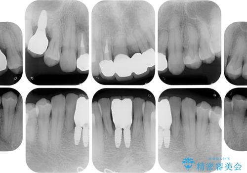 放置した歯列　矯正治療とインプラント治療で劇的に改善の治療後