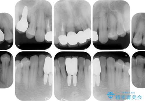 放置した歯列 矯正治療とインプラント治療で劇的に改善の治療後