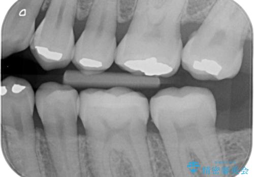 アマルガムを除去　虫歯を除去して、セラミックのつめものにの治療後