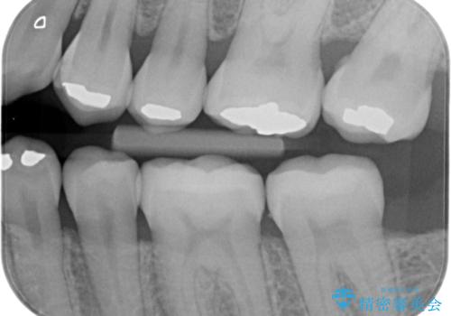アマルガムを除去 虫歯を除去して、セラミックのつめものにの治療後