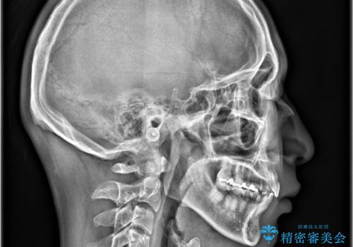 【インビザライン 非抜歯】歯の捻じれと歯のでこぼこを治したい!の治療後