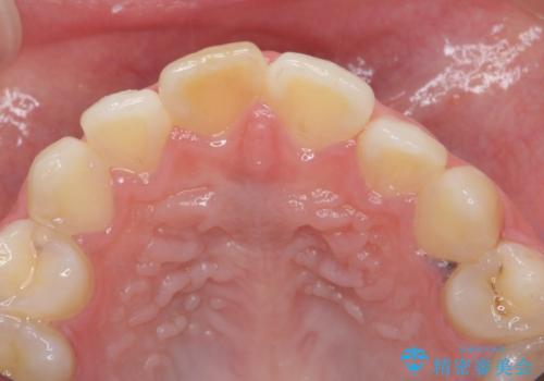 前歯の変色をキレイに セラミッククラウン審美治療の治療前