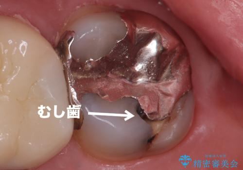 【オールセラミッククラウン】銀歯の下のむし歯