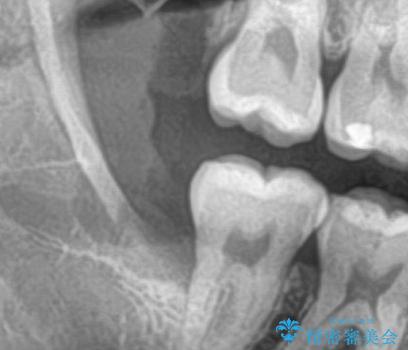 親知らず抜歯の症例 治療後