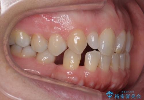 矮小(わいしょう)歯の形をセラミックで自然に 50代女性の治療前
