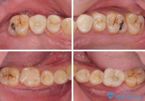 放置した歯列 矯正治療とインプラント治療で劇的に改善の治療後