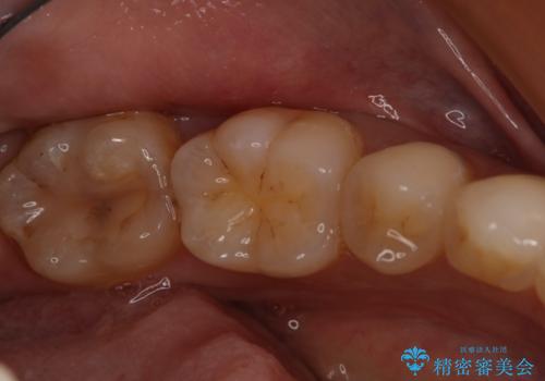 奥歯を綺麗にしたいの治療前