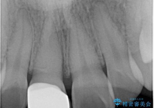 前歯の変色をキレイに セラミッククラウン審美治療の治療後