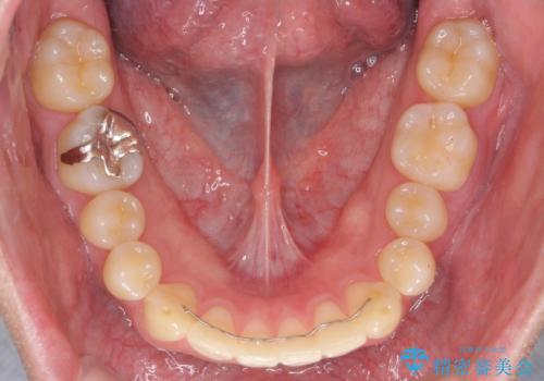 抜歯矯正の長期予後(術後8年目)の治療後