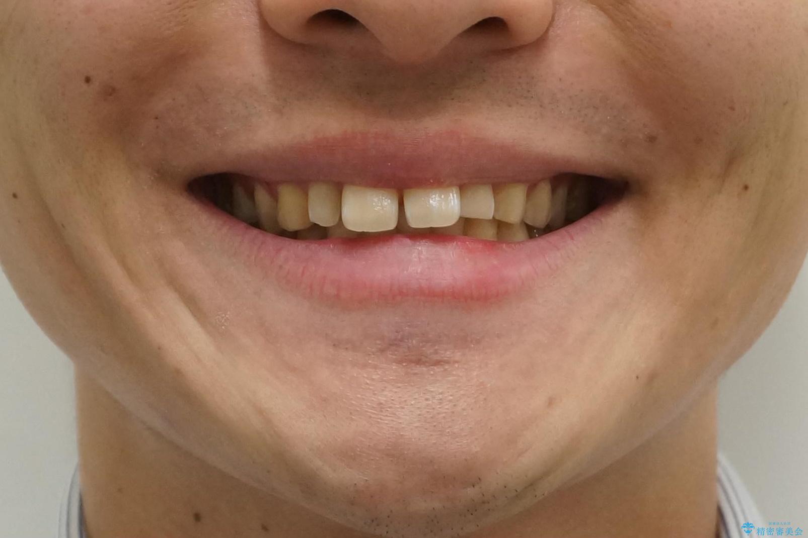 前歯のすき間 小さい歯がある 前歯の並びをきれいにしたいの治療前(顔貌)