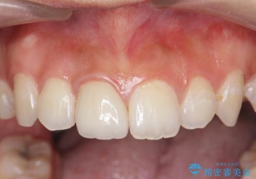 前歯の変色をキレイに セラミッククラウン審美治療の治療後