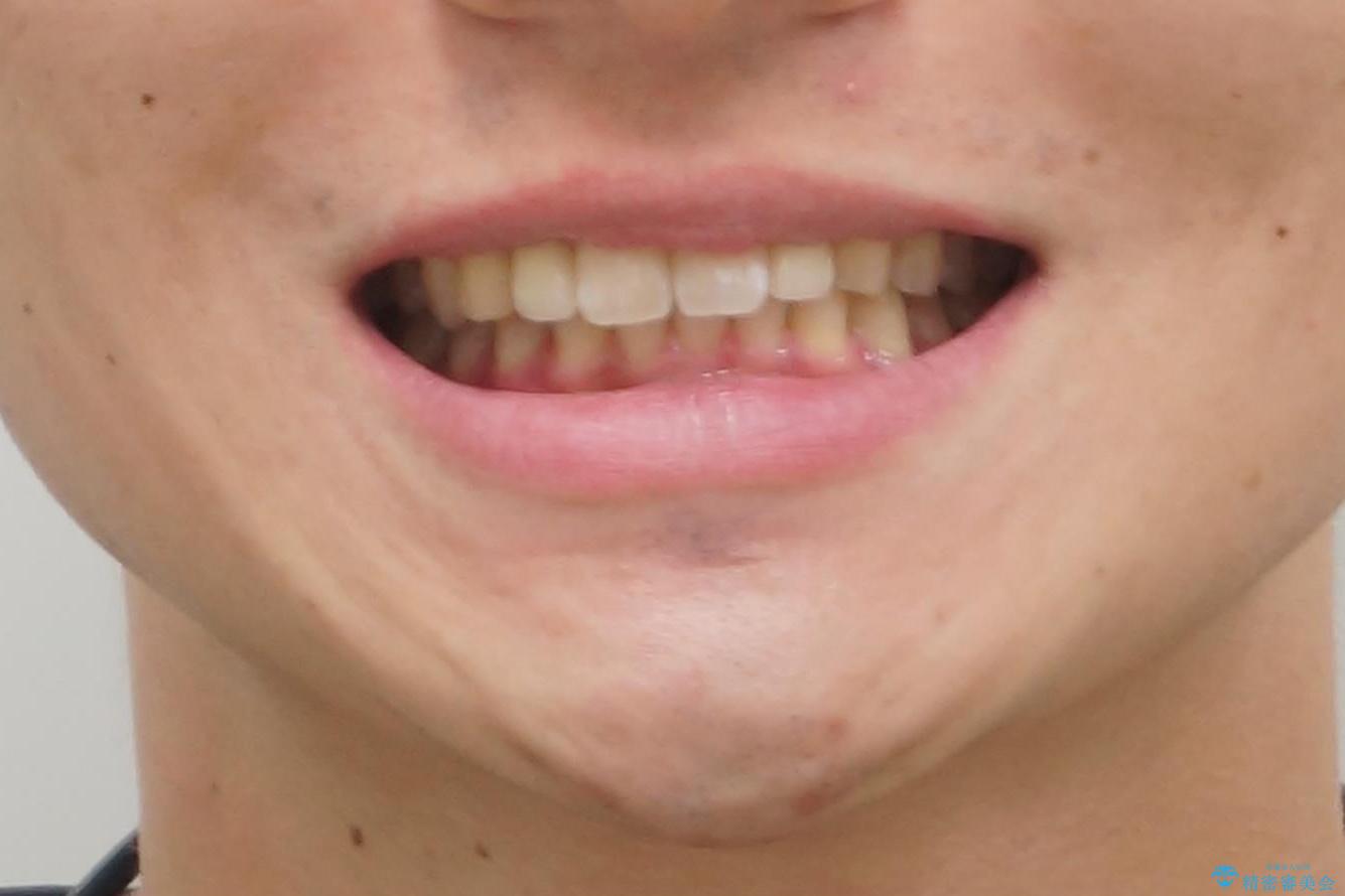 前歯のすき間 小さい歯がある 前歯の並びをきれいにしたいの治療後(顔貌)