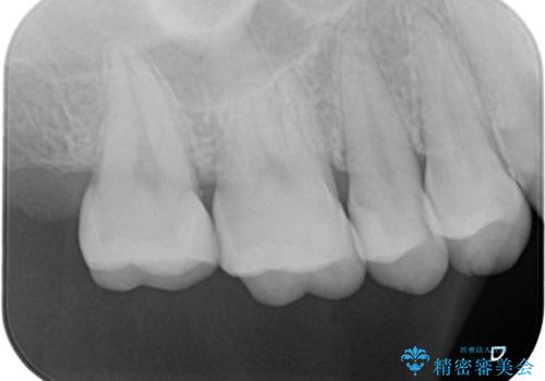 歯と歯の間の虫歯の治療。(コンタクトカリエス)の治療後
