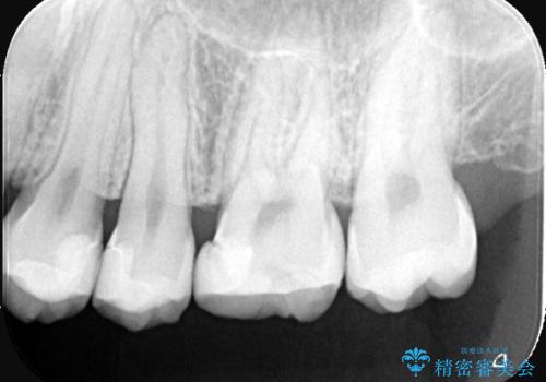 【セラミックインレー】歯が黒くなっているの治療前