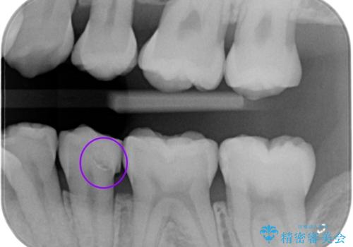 コンタクトカリエスの治療前