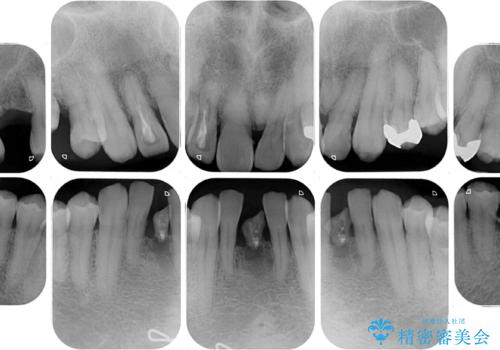 放置した歯列　矯正治療とインプラント治療で劇的に改善の治療前