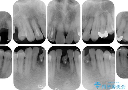 放置した歯列 矯正治療とインプラント治療で劇的に改善の治療前