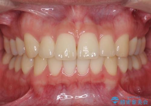抜歯矯正の長期予後(術後8年目)の症例 治療後