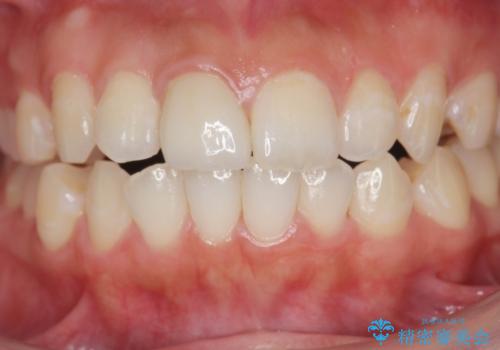前歯の変色をキレイに セラミッククラウン審美治療の治療後
