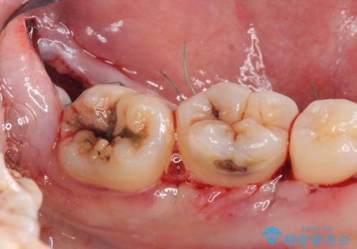 歯冠長延長術をおこなったアプローチの難しい虫歯治療の治療中