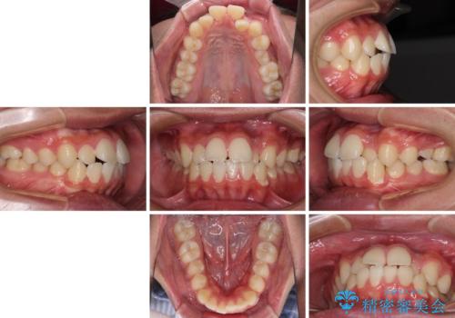 突出した口元 ワイヤー装置で横顔の印象を改善の治療前