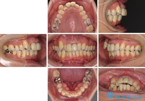 八重歯と突出感を改善　ワイヤー装置での矯正治療の治療前