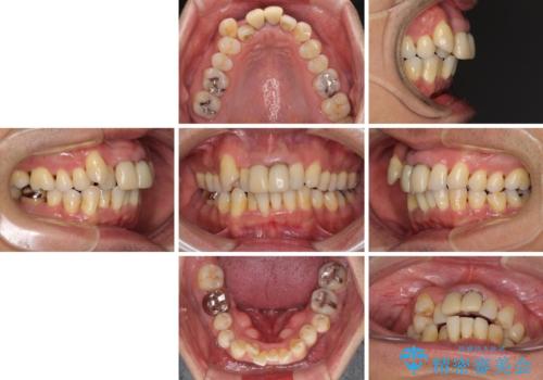 八重歯と突出感を改善 ワイヤー装置での矯正治療の治療前