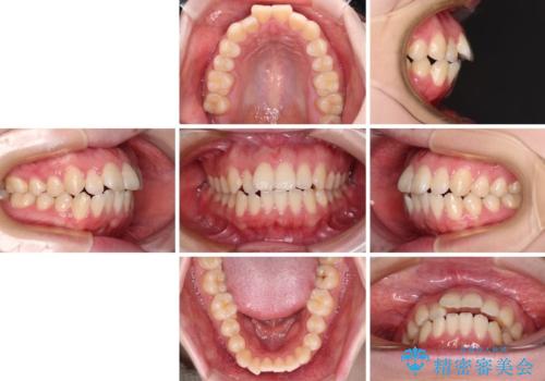 飛び出した上顎前歯　抜歯矯正で横顔の印象を改善の治療前