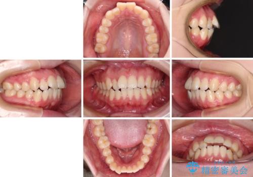飛び出した上顎前歯 抜歯矯正で横顔の印象を改善の治療前