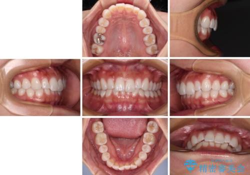 【モニター】前歯のデコボコと小さい前歯 インビザライン矯正とオールセラミッククラウン補綴治療の治療前