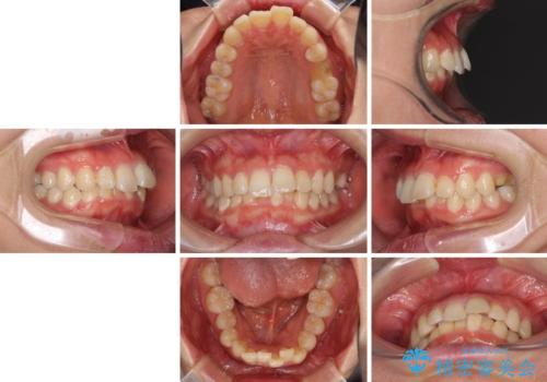 インビザラインが続けられない　ワイヤー矯正に切り替えてデコボコを改善の治療前