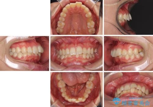 インビザラインが続けられない ワイヤー矯正に切り替えてデコボコを改善の治療前