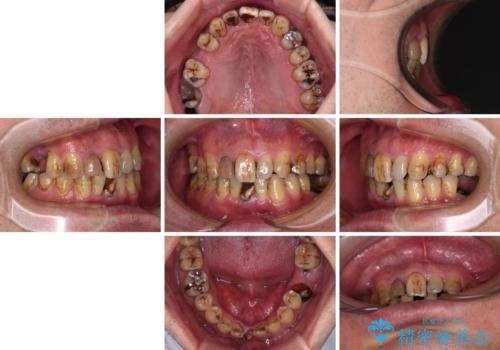放置した歯列　矯正治療とインプラント治療で劇的に改善の治療前
