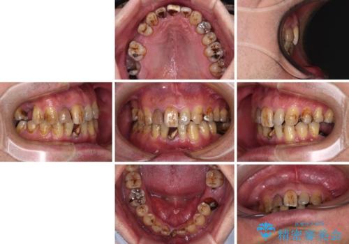 放置した歯列 矯正治療とインプラント治療で劇的に改善の治療前