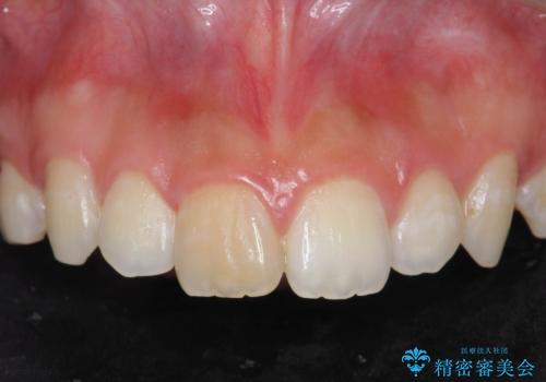 前歯の変色をキレイに セラミッククラウン審美治療の治療前