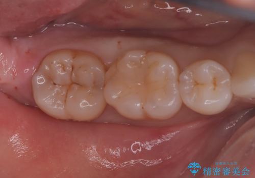 【再生療法】急に歯茎がすごく痛くなったの症例 治療前