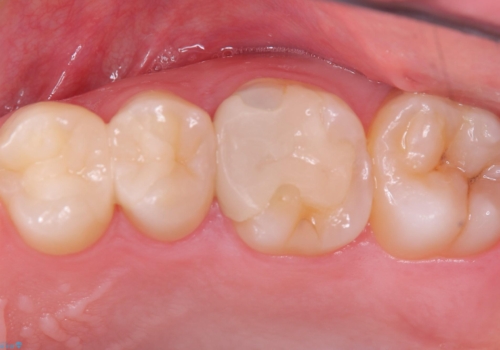 【セラミックインレー】歯が黒くなっているの症例 治療前