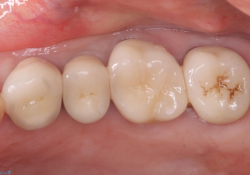 【セラミッククラウン】昔入れた被せものの黒いところが気になるの治療前