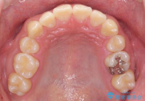 抜歯矯正の長期予後(術後8年目)の治療後