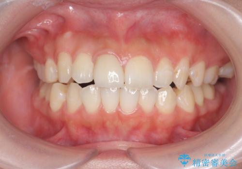 前歯の変色をキレイに セラミッククラウン審美治療の治療後